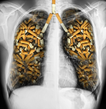 O cigarro possui polônio, o que pode causar câncer de pulmão