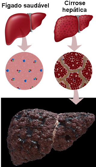 Ilustração de fígado com cirrose hepática em virtude do consumo excessivo de álcool
